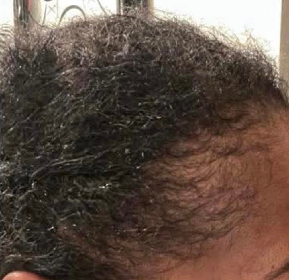 Root Renew – In-Home Hair Rejuvenation Therapy