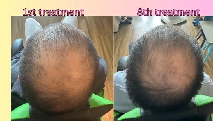 Root Renew – In-Home Hair Rejuvenation Therapy